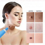 DermoPen TR-36™ | Kit Profissional para Remoção de Verrugas e Sinais